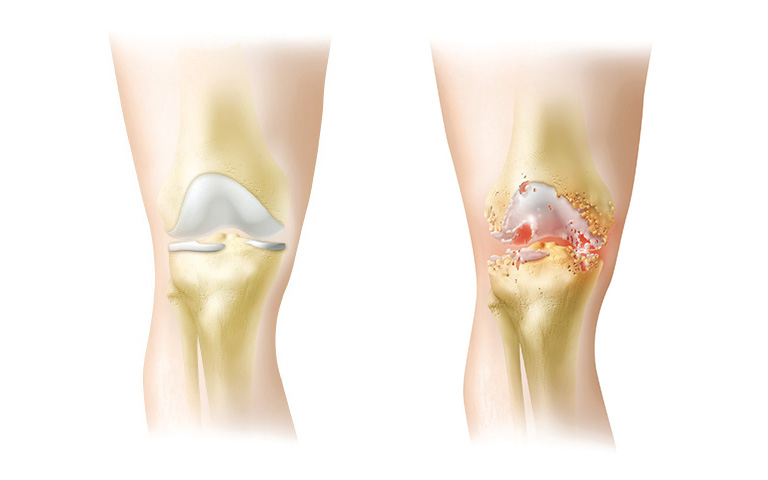 knie-gesund_artrose-(1).jpg