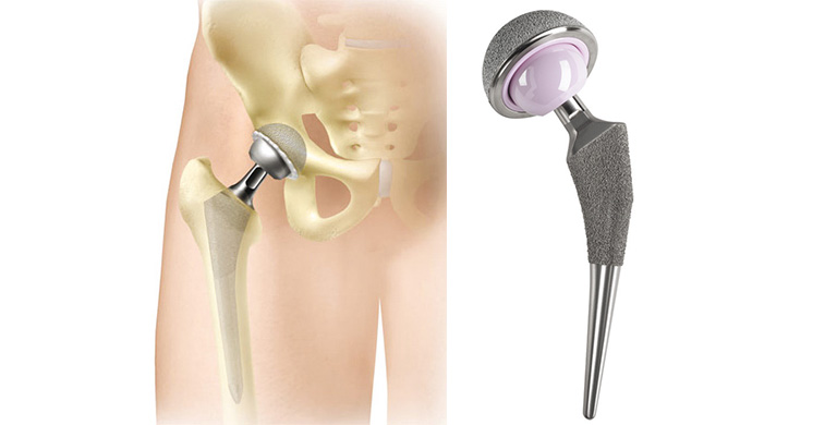 huefte-prothese.jpg