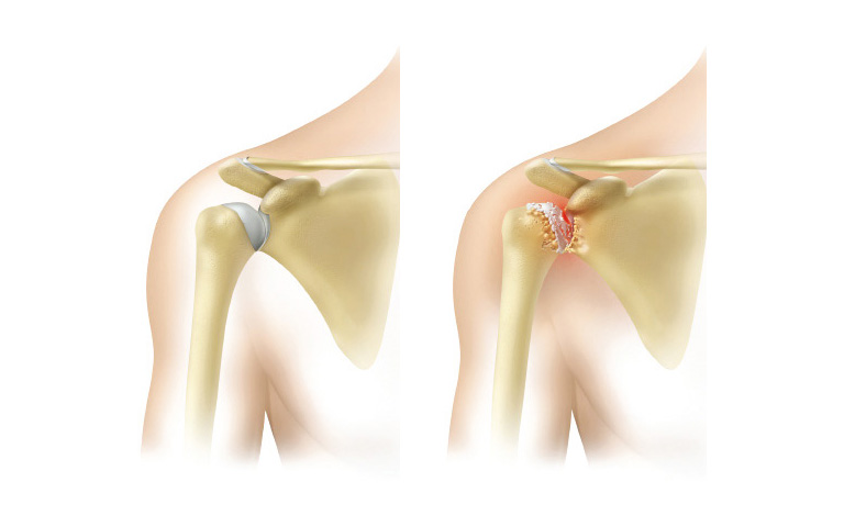 schulter_gesund-artrose.jpg