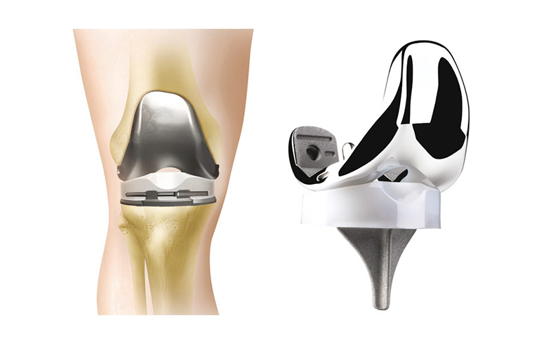 knie-prothese.jpg